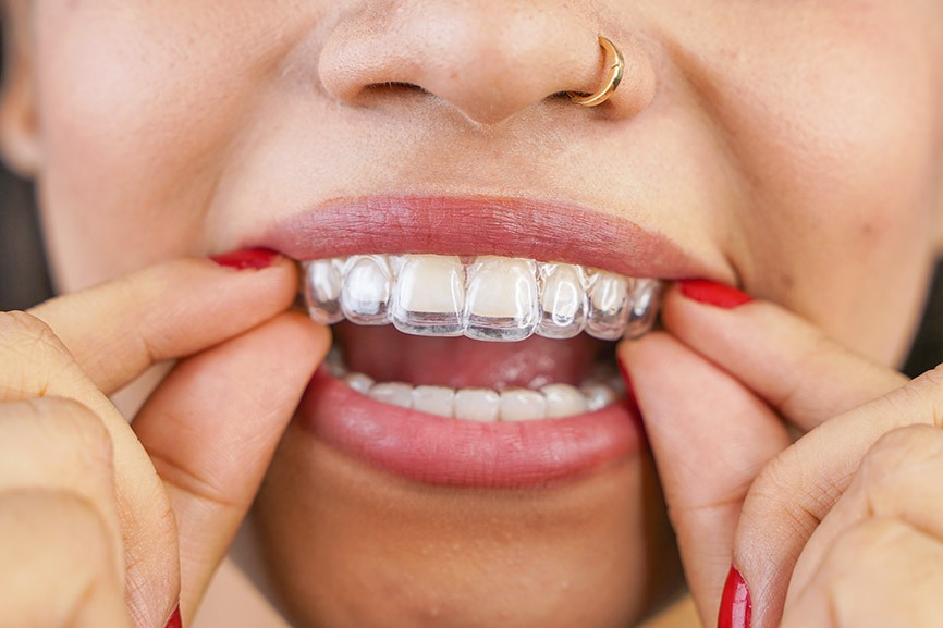 Featured image for “How Long Does It Take Invisalign To Work?”