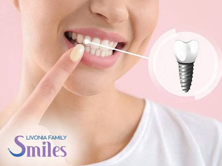 Dental Implants in Livonia
