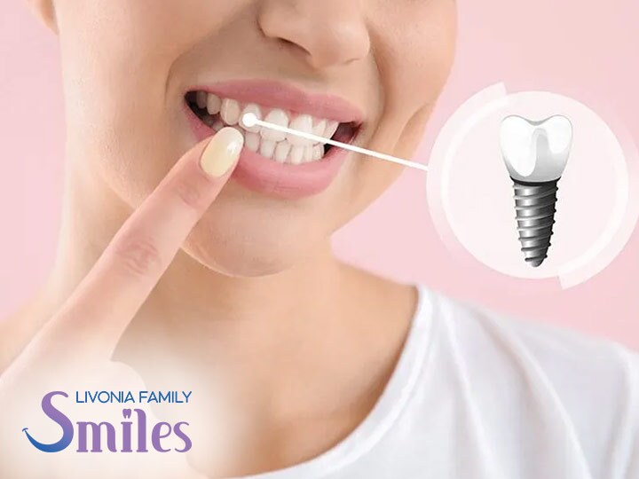 Dental Implants in Livonia