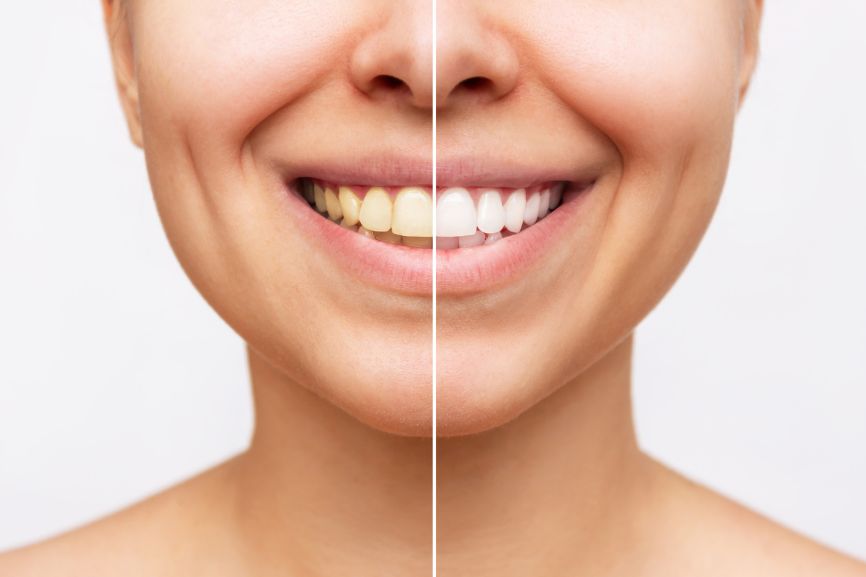 Featured image for “How Long Does Teeth  Whitening Last?”